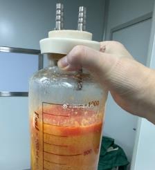 金昌水动力吸脂手术要做多久？